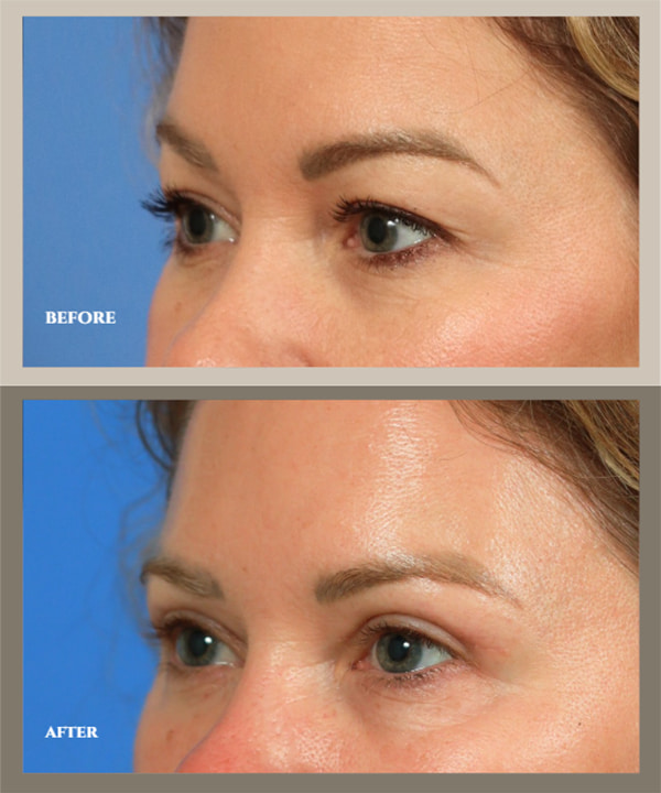 5 Myths About Blepharoplasty, Debunked by a Surgeon