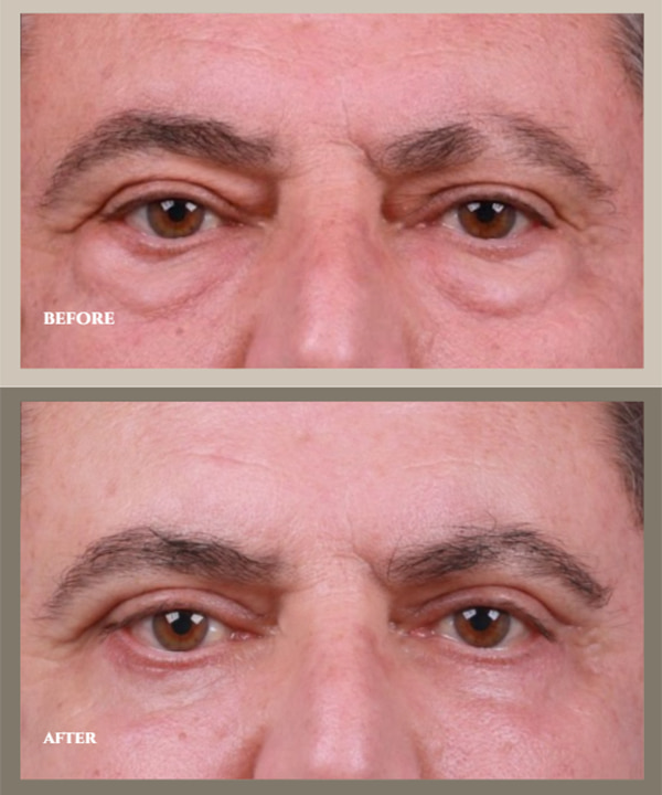 5 Myths About Blepharoplasty, Debunked by a Surgeon