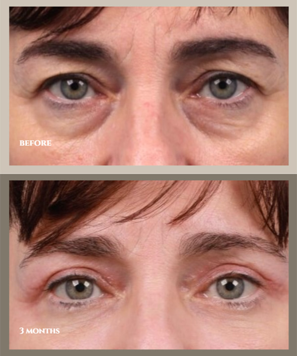 5 Myths About Blepharoplasty, Debunked by a Surgeon