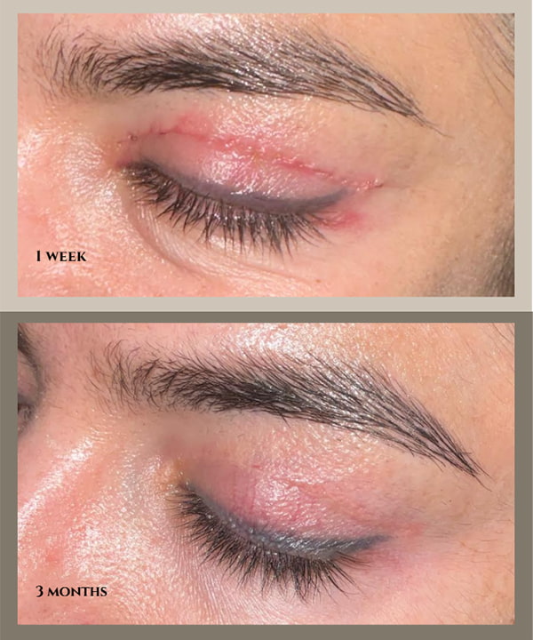 5 Myths About Blepharoplasty, Debunked by a Surgeon