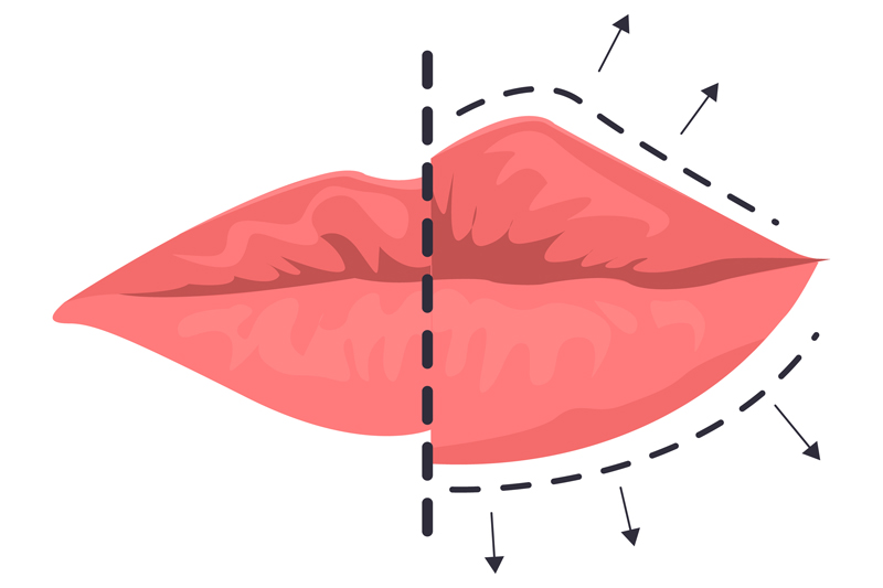 Lip Fillers vs. Lip Flip vs. Lip Lift | Finding Your Perfect Lip Enhancement