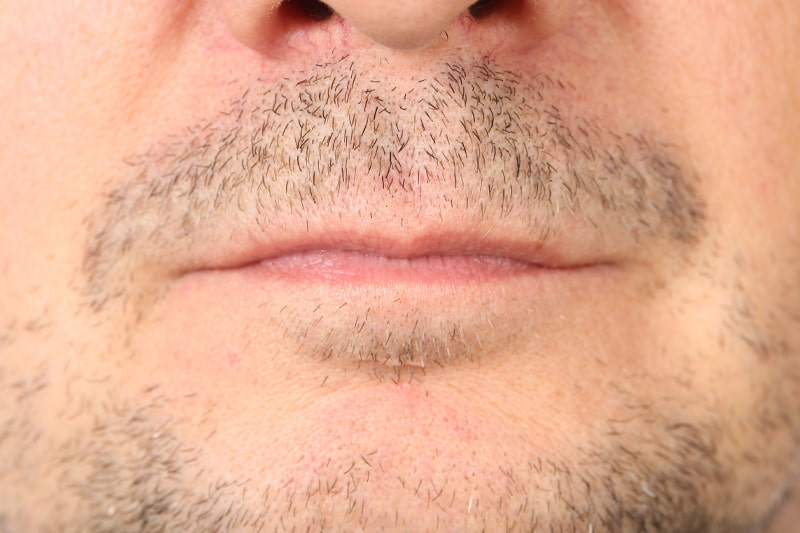 Lip Fillers vs. Lip Flip vs. Lip Lift | Finding Your Perfect Lip Enhancement