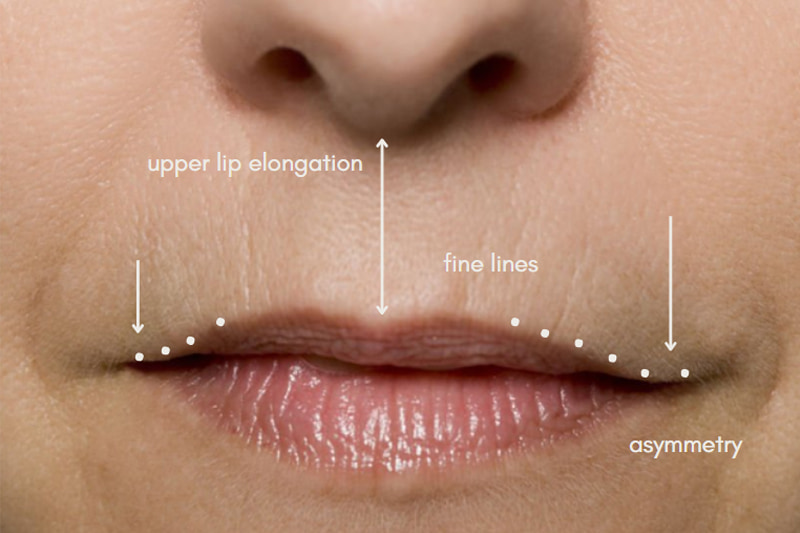 Lip Fillers vs. Lip Flip vs. Lip Lift | Finding Your Perfect Lip Enhancement