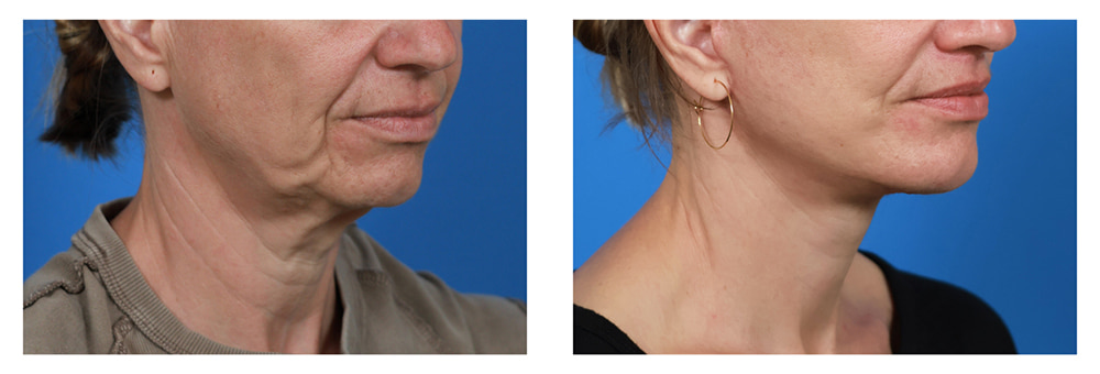 Mini vs. Full Facelift: How I Decide