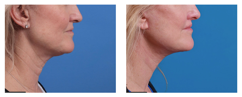 Mini vs. Full Facelift: How I Decide