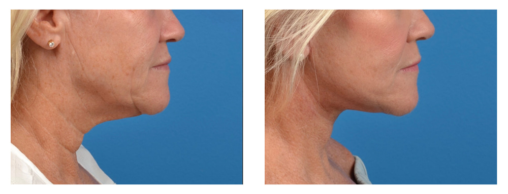 Mini vs. Full Facelift: How I Decide