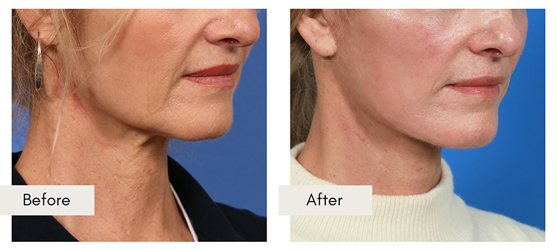 The Battle of Fillers Versus Surgery