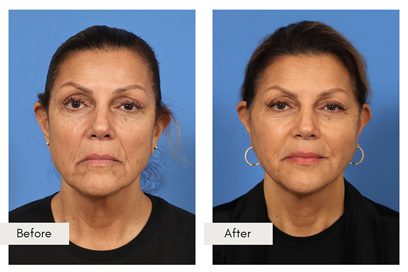 The Battle of Fillers Versus Surgery