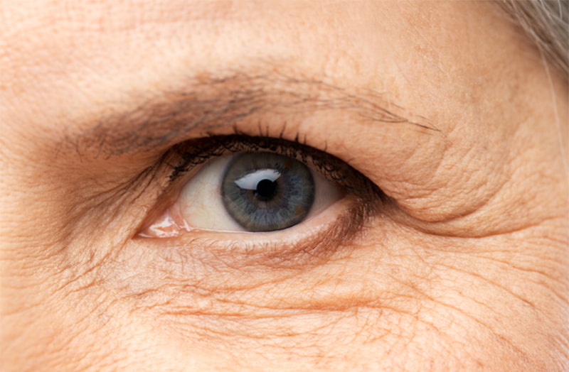 The New BBL: Blepharoplasty & Brow Lift