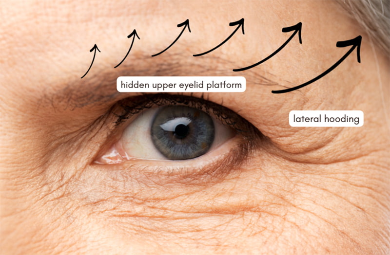 The New BBL: Blepharoplasty & Brow Lift