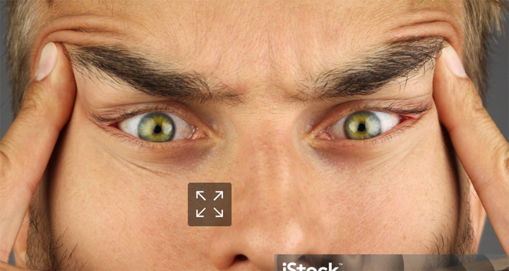 The New BBL: Blepharoplasty & Brow Lift