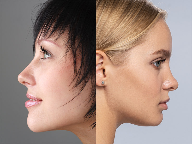 Top 5 Rhinoplasty Myths Debunked
