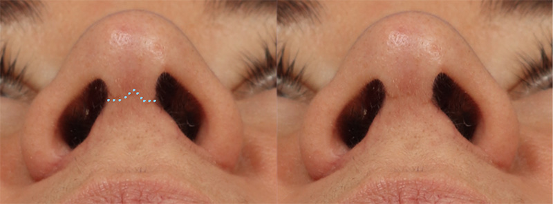 Top 5 Rhinoplasty Myths Debunked