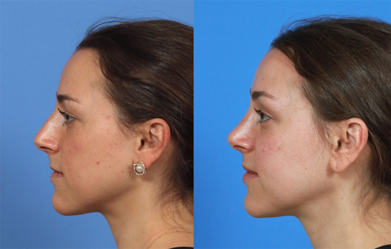 Top 5 Rhinoplasty Myths Debunked