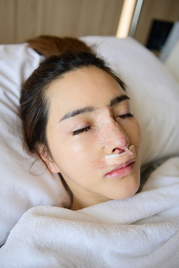 Understanding Rhinoplasty Recovery at Every Stage