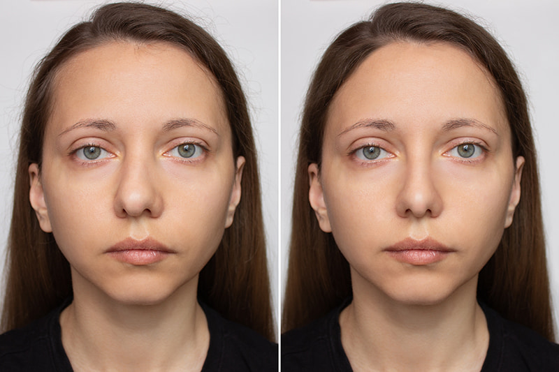 Why Today’s Rhinoplasty Is Safer, Smarter, and More Natural