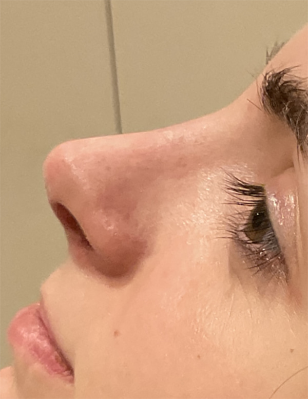 Why Today’s Rhinoplasty Is Safer, Smarter, and More Natural