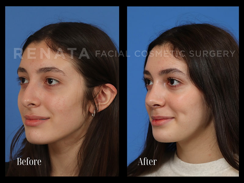 Why Today’s Rhinoplasty Is Safer, Smarter, and More Natural