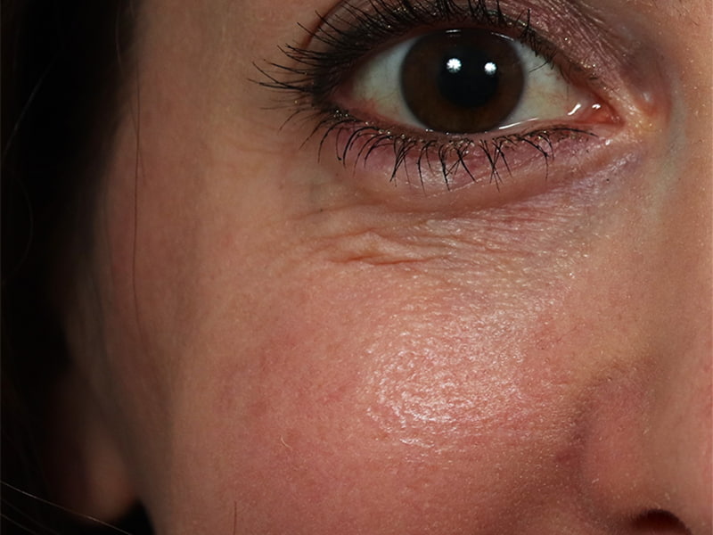 CO2 Laser Resurfacing Before & After Image