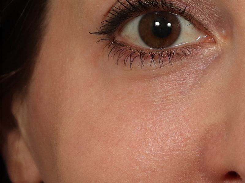CO2 Laser Resurfacing Before & After Image