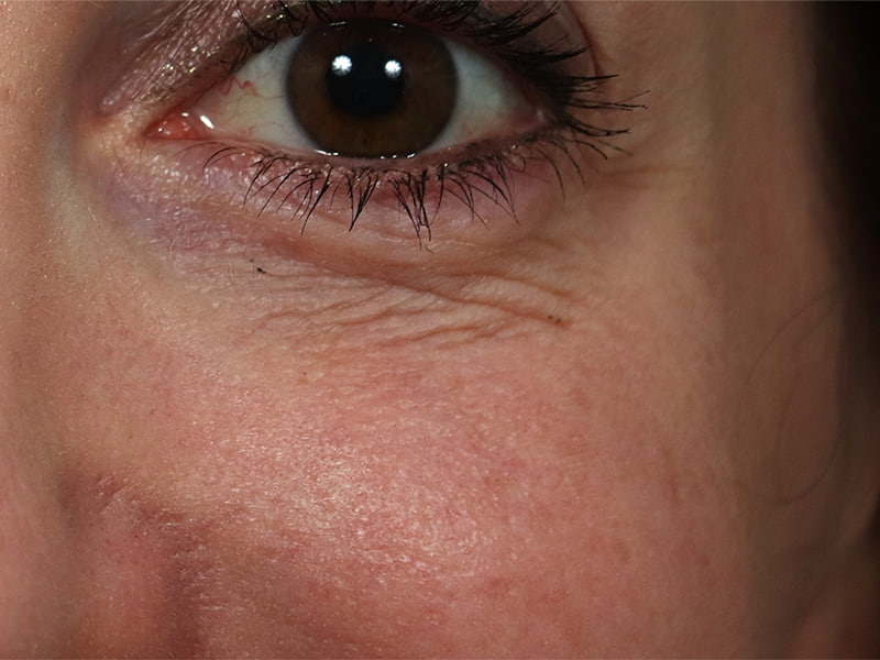 CO2 Laser Resurfacing Before & After Image