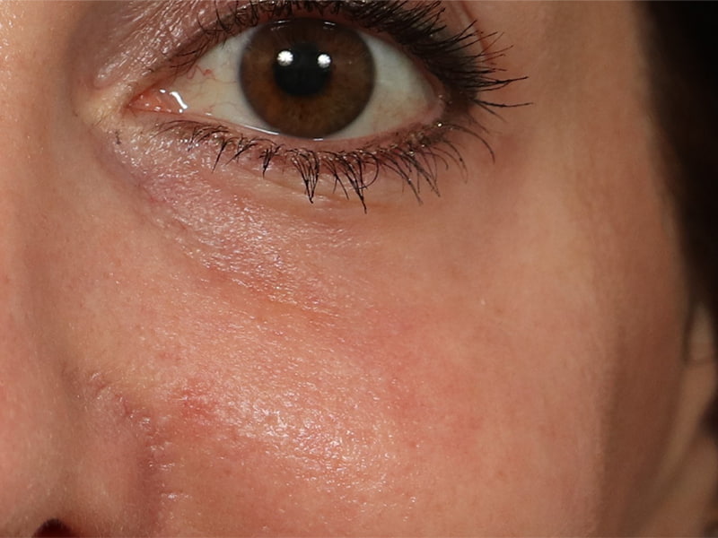 CO2 Laser Resurfacing Before & After Image