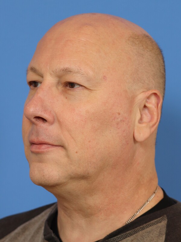 CO2 Laser Resurfacing Before & After Image