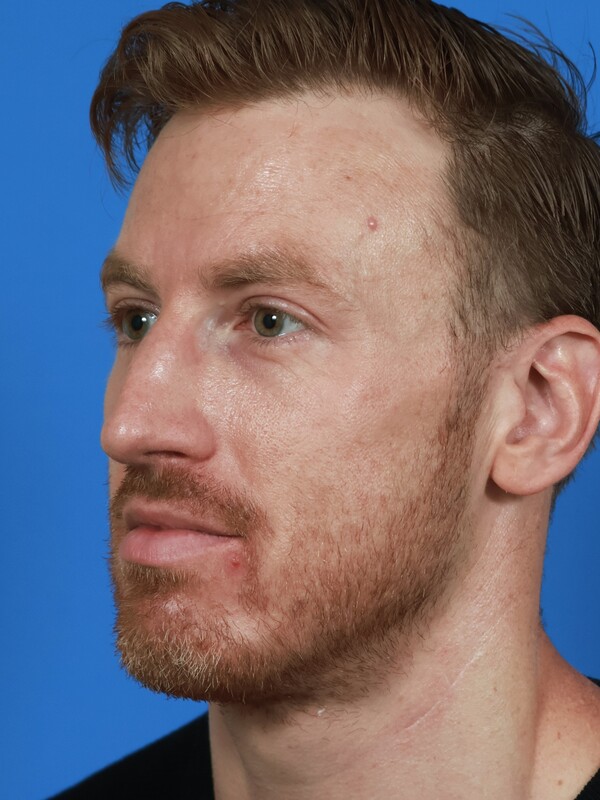 CO2 Laser Resurfacing Before & After Image