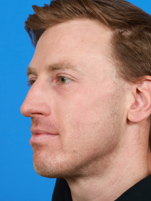 CO2 Laser Resurfacing Before & After Image