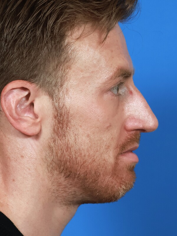 CO2 Laser Resurfacing Before & After Image