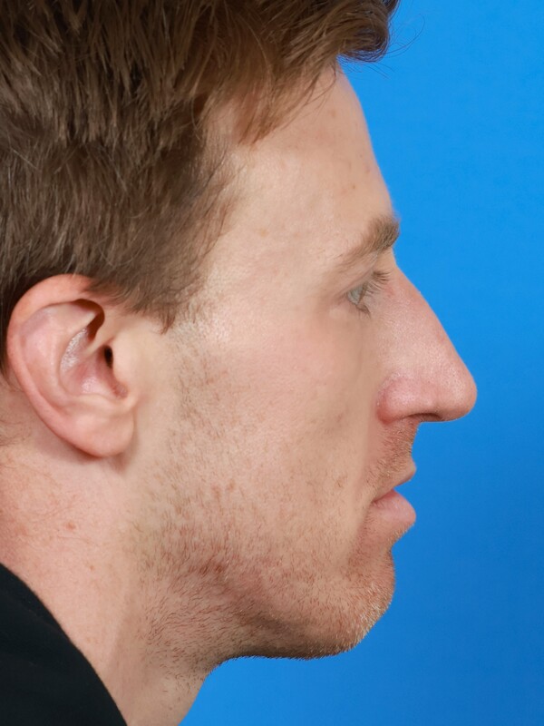 CO2 Laser Resurfacing Before & After Image