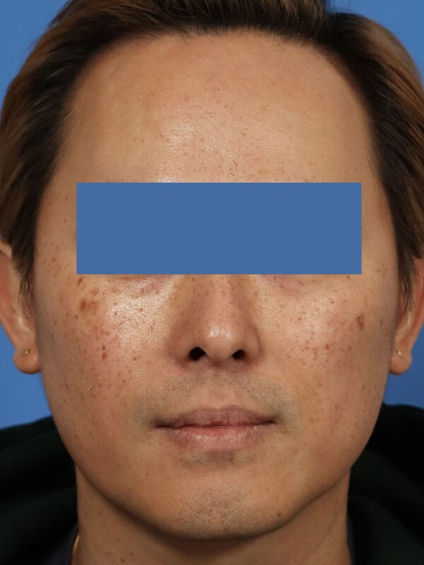 CO2 Laser Resurfacing Before & After Image