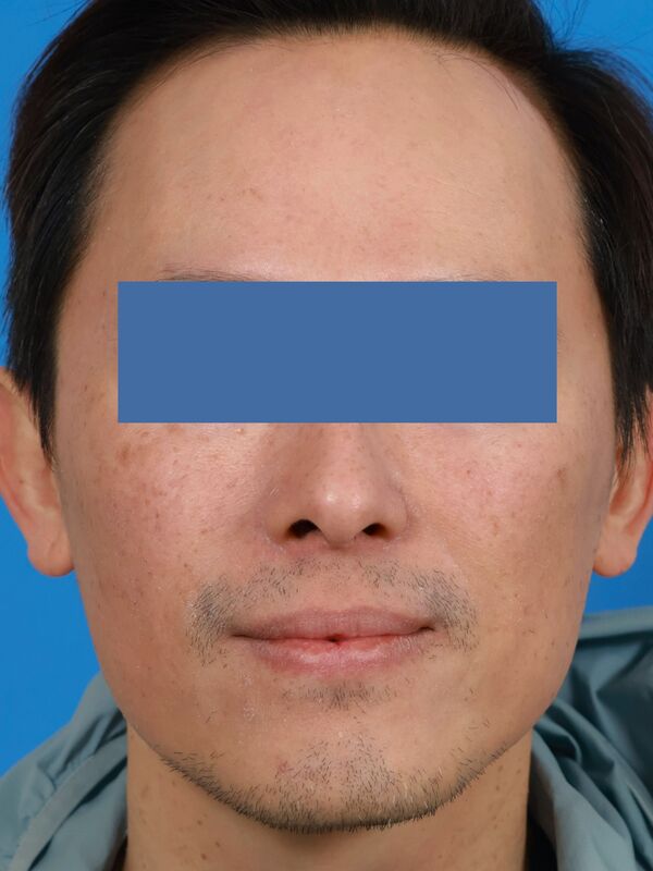 CO2 Laser Resurfacing Before & After Image