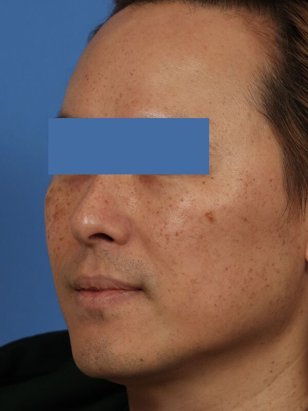 CO2 Laser Resurfacing Before & After Image