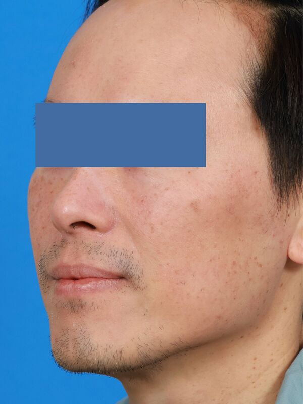 CO2 Laser Resurfacing Before & After Image