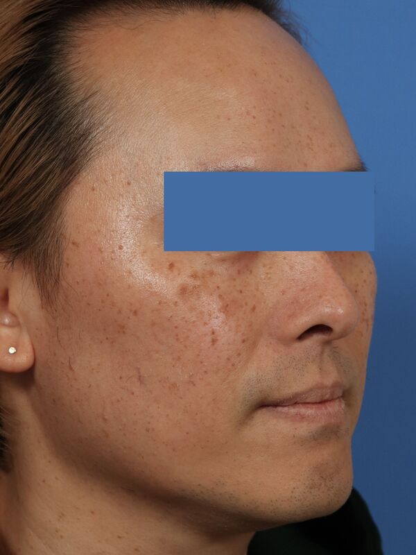 CO2 Laser Resurfacing Before & After Image