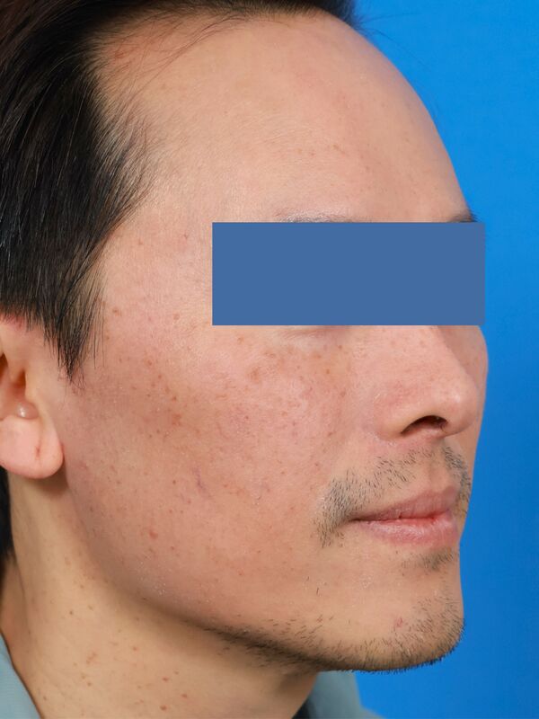 CO2 Laser Resurfacing Before & After Image