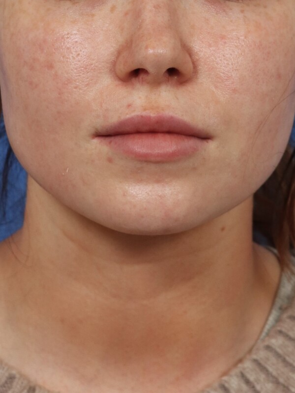 CO2 Laser Resurfacing Before & After Image