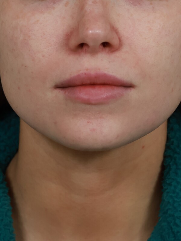 CO2 Laser Resurfacing Before & After Image