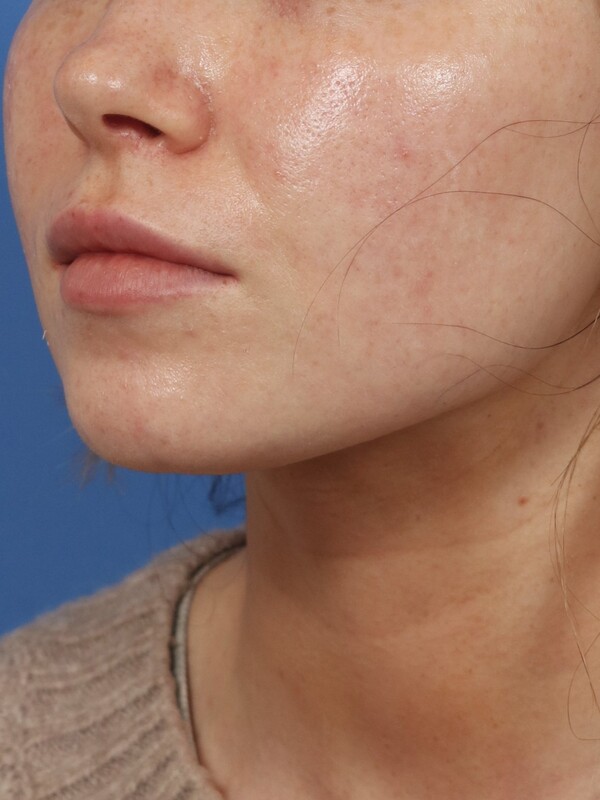 CO2 Laser Resurfacing Before & After Image