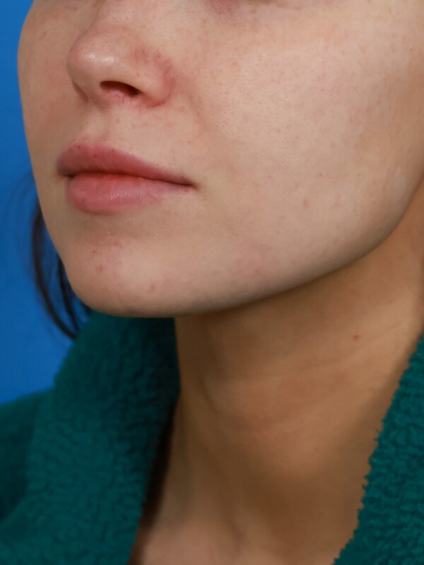 CO2 Laser Resurfacing Before & After Image