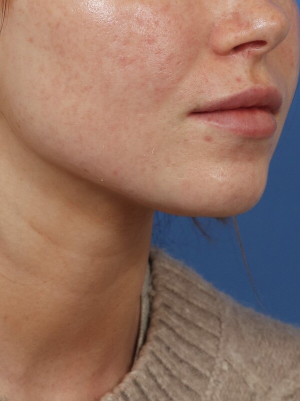 CO2 Laser Resurfacing Before & After Image
