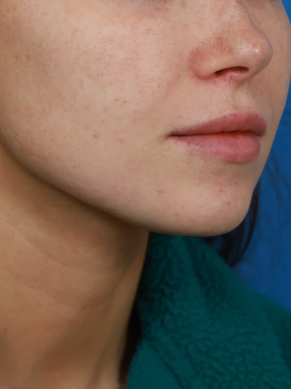CO2 Laser Resurfacing Before & After Image