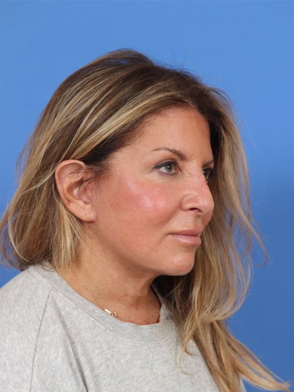 CO2 Laser Resurfacing Before & After Image