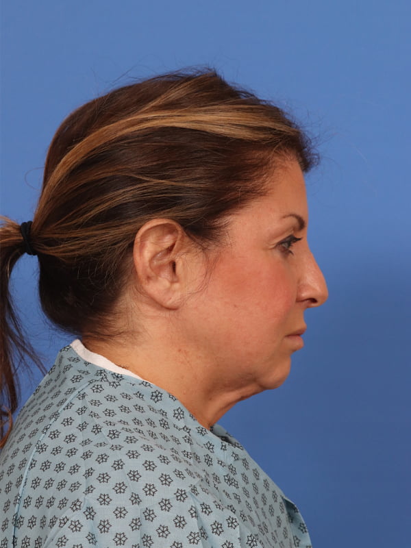 CO2 Laser Resurfacing Before & After Image