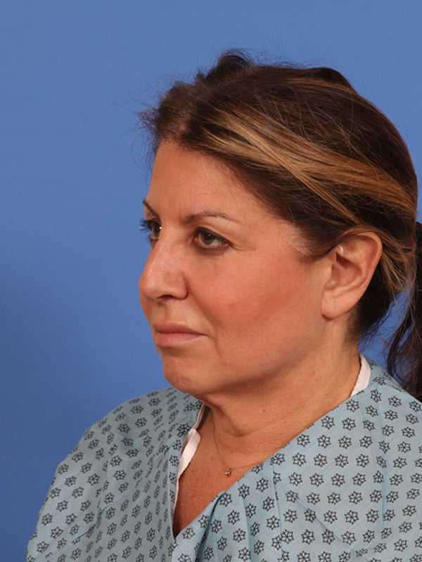 CO2 Laser Resurfacing Before & After Image