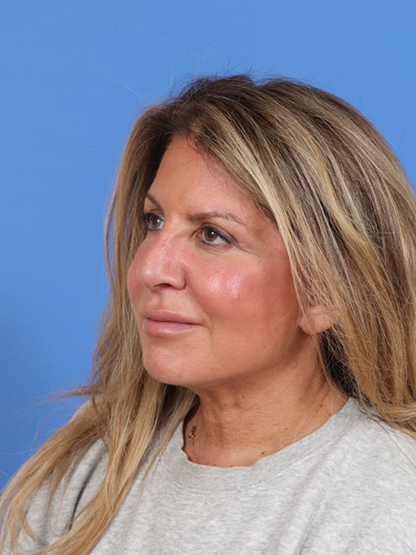 CO2 Laser Resurfacing Before & After Image