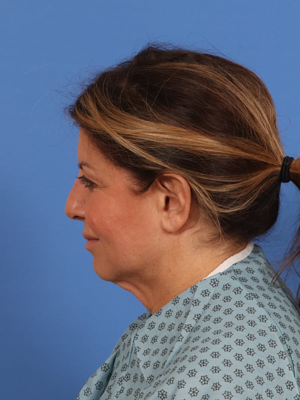 CO2 Laser Resurfacing Before & After Image