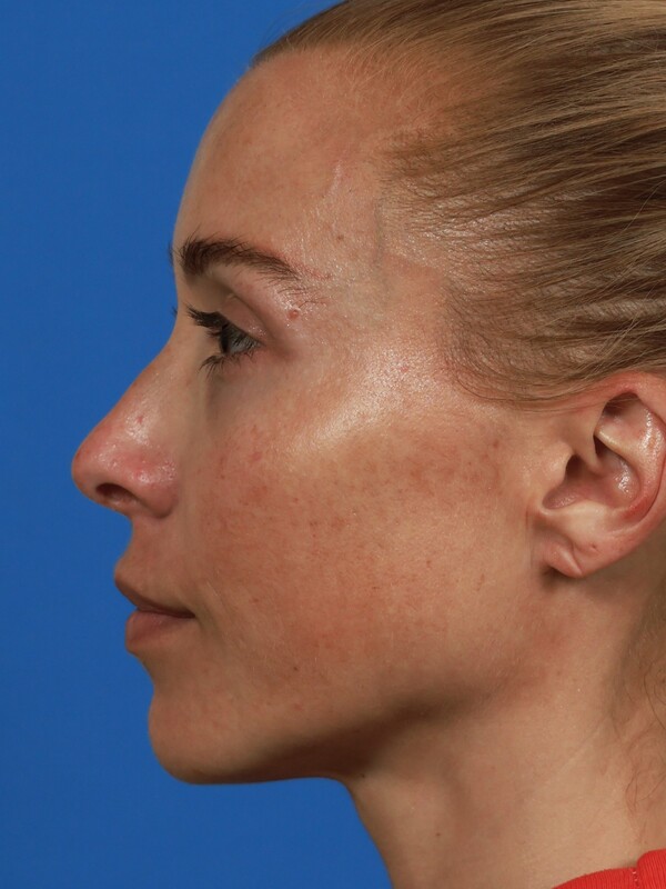 CO2 Laser Resurfacing Before & After Image