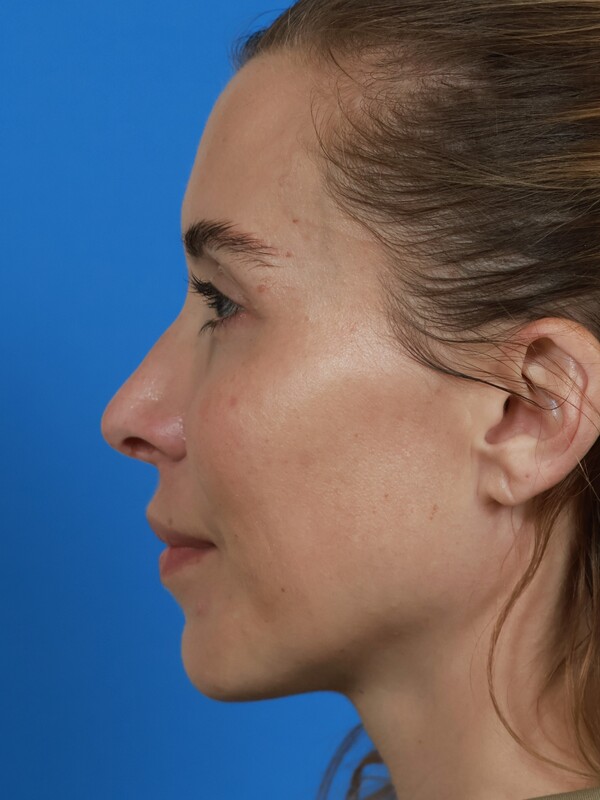 CO2 Laser Resurfacing Before & After Image